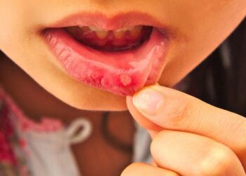 Sering Sariawan? Ini Penyebab, Cara Mengobati dan Kapan Harus ke Dokter